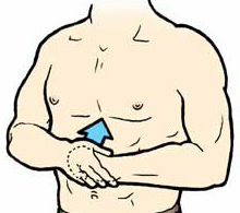 The use of the Heimlich maneuver by oneself.