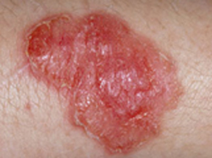Scabies infecting the skin.
