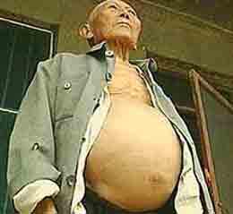 A patient who is infected with schistosomiasis.